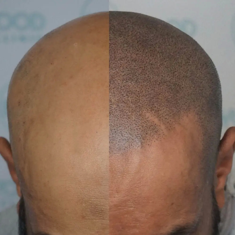 Find out how painful scalp micropigmentation north London